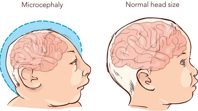 ज़ीका का बच्चों पर असर