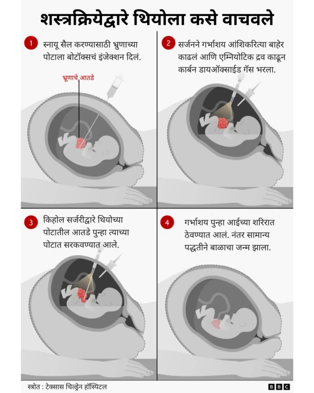 प्रसूतीपूर्व शस्त्रक्रियेचे चार टप्पे.