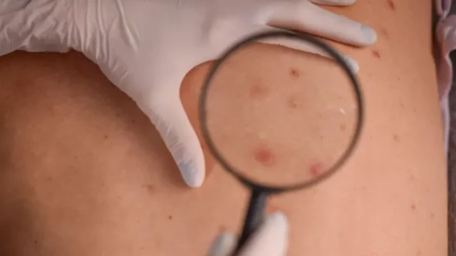 ਚਮੜੀ ਦੇ ਕੈਂਸਰ ਦੇ ਲੱਛਣ