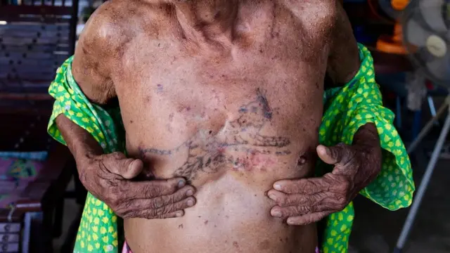 วิชัย ทองสวัสดิ์ วัย 86 ปี ผู้ป่วยโรคมะเร็งผิวหนัง