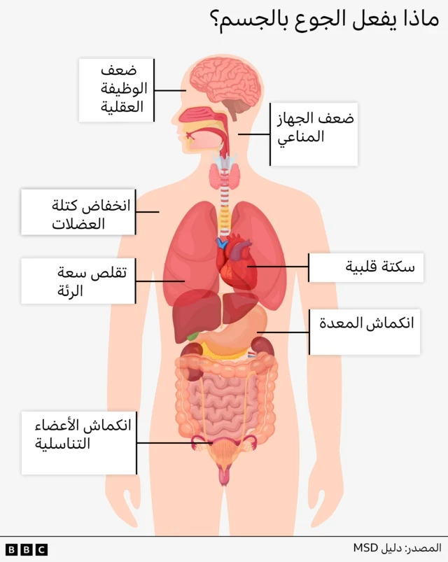 رسم لجسم الإنسان وأعضائه الداخلية، عليه شرح لتأثر الجوع على الجسم: ضعف الجهاز المناعي، وضعف الوظيفة العقلية، وانخفاض الكتلة العضلية، وتقلص سعة الرئة، والسكتة القلبية، وانكماش المعدة، وانكماش الأعضاء التناسلية.