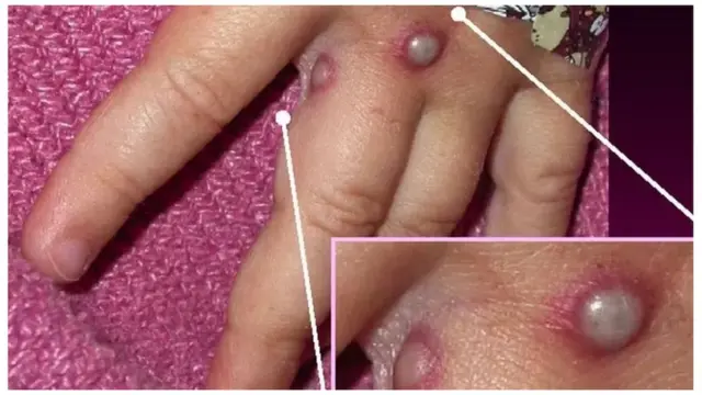 मंकीपॉक्स