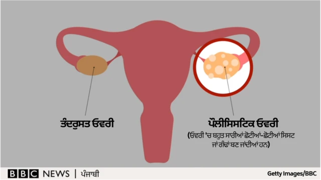 ਪੀਸੀਓਡੀ