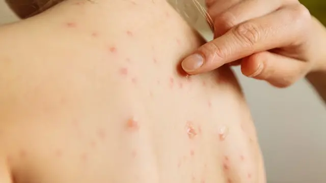 Pepas que aparecen con el sarampión.