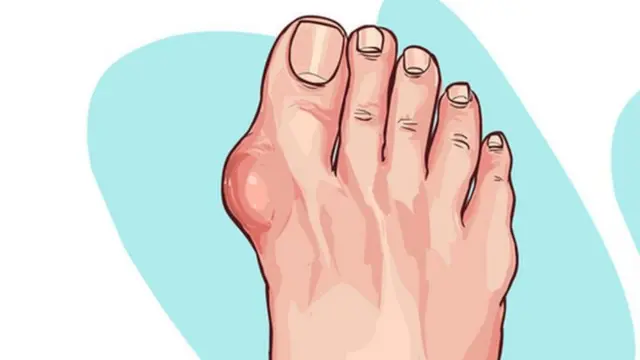 కీళ్ల నొప్పులు