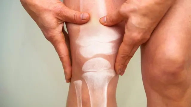 Ilustrasi osteoporosis.