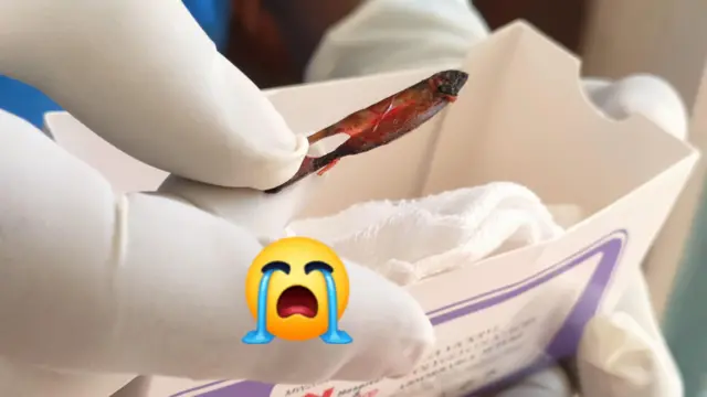 Aworan abẹ ti wọn gbe jade ninu ikun arabinrin naa