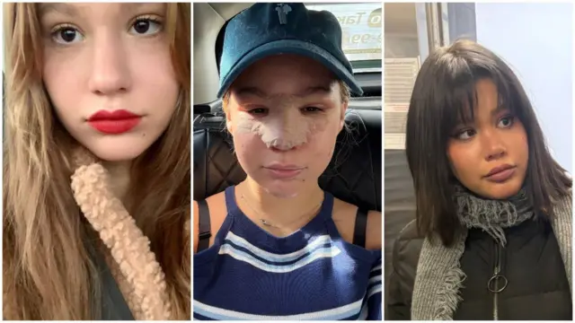 Полина Аксенова до и после ринопластики