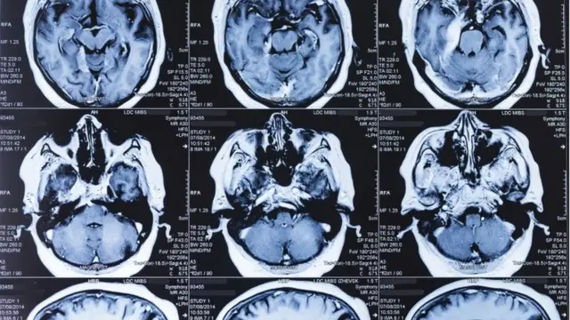 人腦核磁共振影像