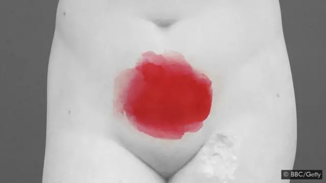 L'hystérectomie n'est pas un remède, et l'endométriose peut survenir par la suite