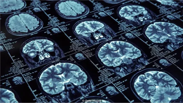 Məlumatı uzunmüddətli yaddaşa çevirmək üçün yavaş dalğalı yuxu zamanı hipokampus və neokorteks əlaqə qurur