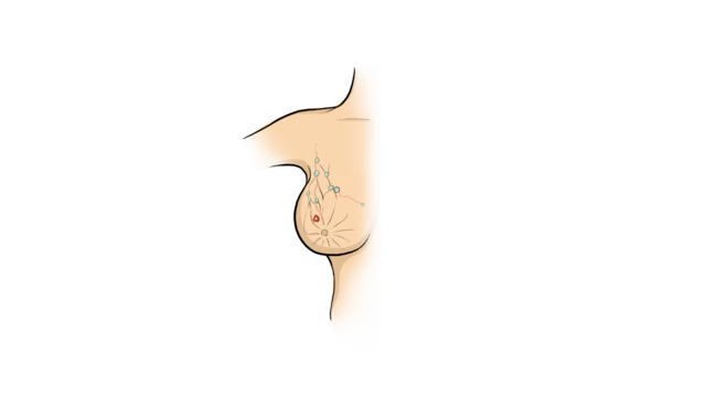 چ﻿ھاتی کا کینسر