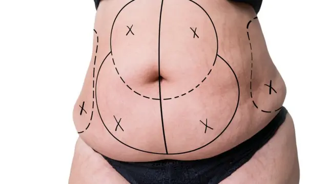 वजन कमी करणारी लायपोसक्शन शस्त्रक्रिया काय असते?