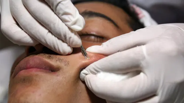 หากรักษาสิวเบื้องต้นแล้วยังไม่หาย หรือสิวเริ่มส่งผลกระทบต่อความรู้สึก ก็เป็นสัญญาณว่าถึงเวลาแล้วที่คุณจะต้องไปพบแพทย์