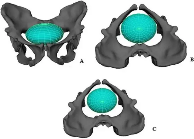 Reconstrucción digital de la pelvis de Australopithecus sediba