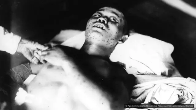 Ranjeni 21-godišnji vojnik koji je bio izložen bombardovanju sa potkožnim podlivima na telu