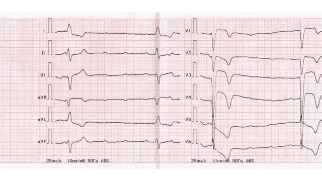 కార్డియాక్ అరెస్ట్