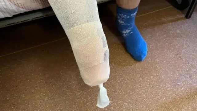 Мешканець, який втратив нижню частину ноги, наступивши на протипіхотну міну ПФМ біля свого будинку