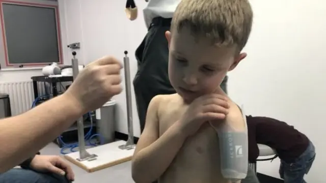 джейкоб, протез