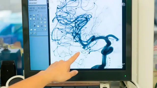 What is Brain Aneurysm