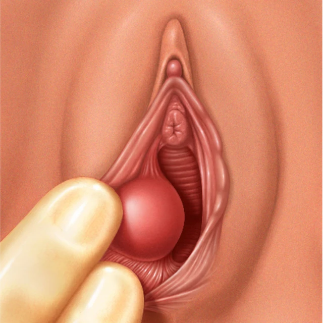 Quiste de la glándula Bartolino