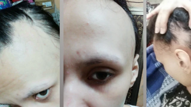 ایلوپیشیا کا شکار خاتون