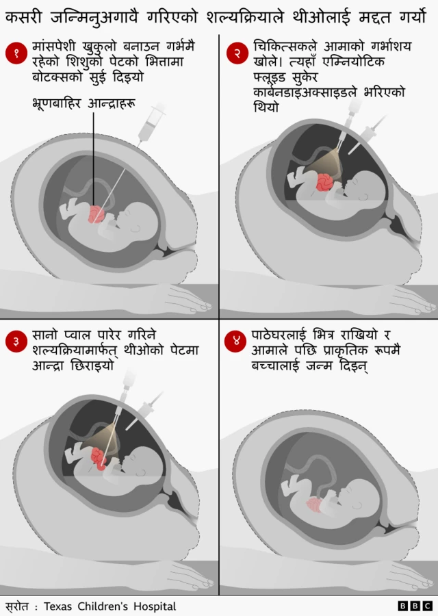 भ्रूणलाई बोटक्स सुई दिएर मांसपेशीलाई शिथिल पारिएको थियो