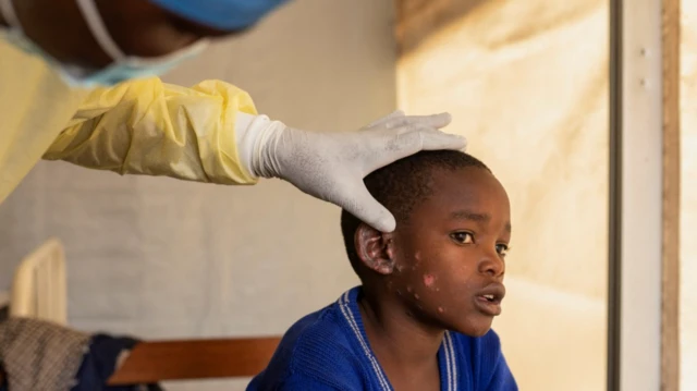 mpox, cacar monyet, kongo