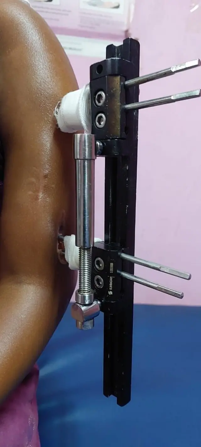 கையில் பொருத்தப்பட்டுள்ள external fixator கருவி 