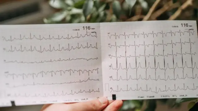 ECG