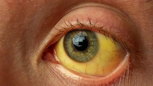 гепатит, жовтянка 