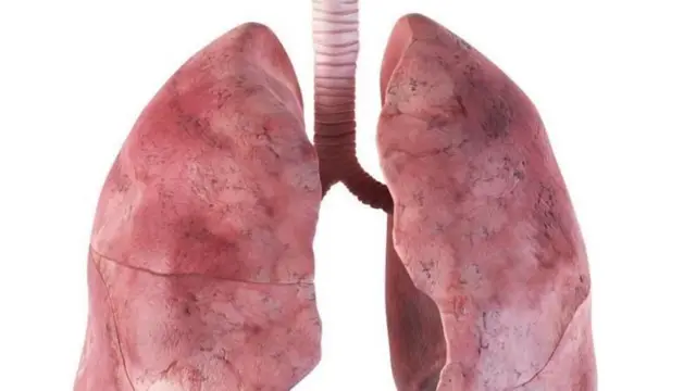 न्यूमोनिया जर जिवाणुमुळे झाला असेल, त्यावर अँटिबायोटिक्सद्वारे उपचार करता येतात