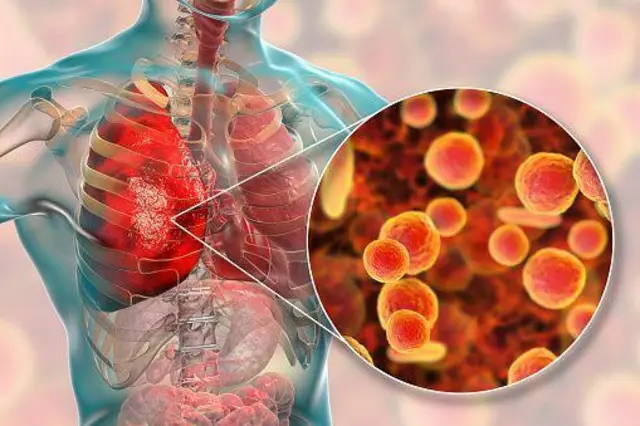 న్యుమోనియా