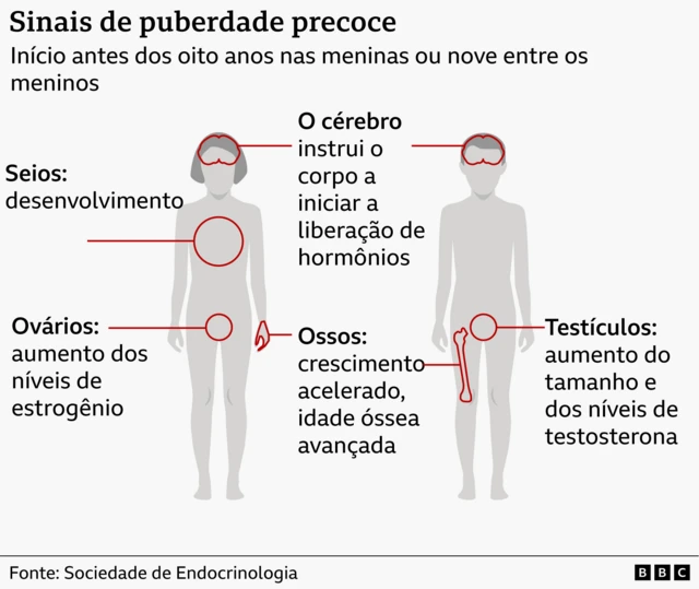 Ilustração gráfica de corpo masculino e feminino, indicando os sinais da puberdade precoce em crianças
