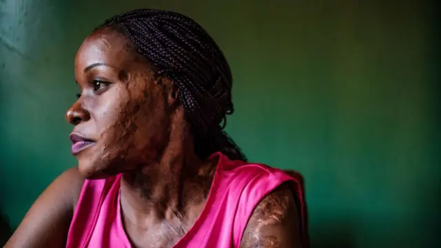 serangan air keras, Uganda