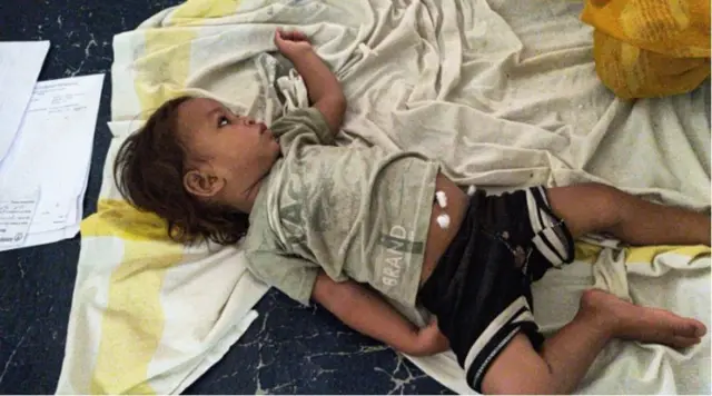 Daa'ima waggaa tokkoo hospitaala ciisaa jiru