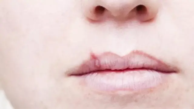 కిస్సింగ్ డిసీజ్