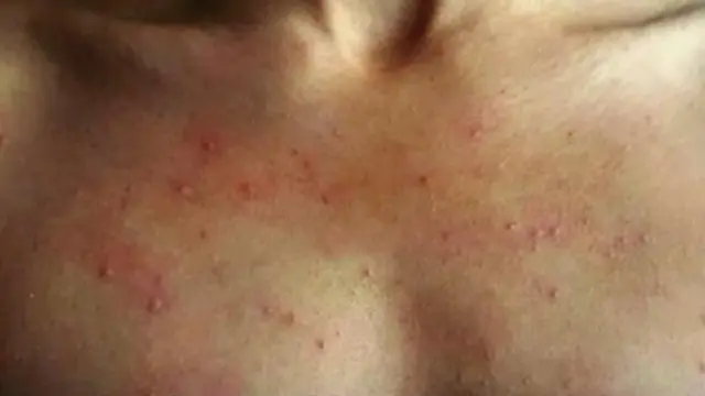 পানি লাগলেই এমন র‍্যাশ ওঠে শরীরে