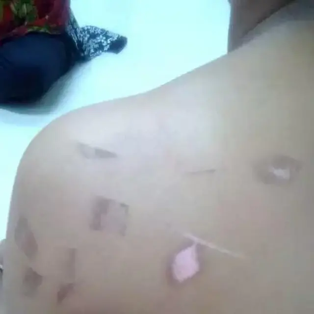 ঘাড়ে-পিঠে ছ্যাঁকা দেয়া হয়েছে এই নারীকে।