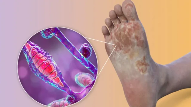 ਕਿਲਰ ਫੰਗਸ