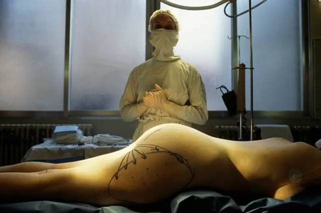 اس کے علاج کے بارے میں زیادہ معلومات نہیں ہیں لیکن لیپوسکشن کے ذریعے اس سلسلے میں کچھ کیا جا سکتا ہے