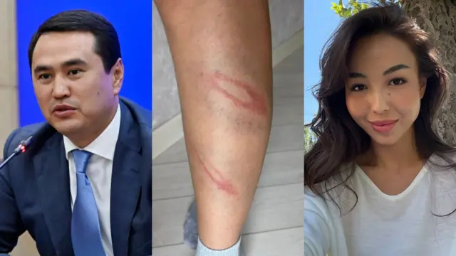 фото коллаж: депутат Элдар Сулймонов, Асел Аазаматова ва кўкарган оёқ