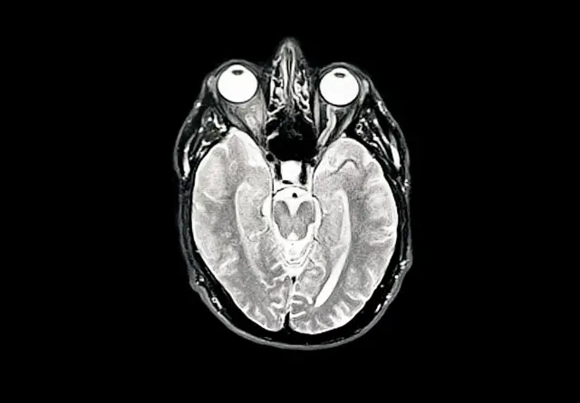 مسح بالأشعة تحت الحمراء لدماغ يظهر الخرف المبكر/ألزهايمر في 30 مايو 2025 في لندن، إنجلترا.
