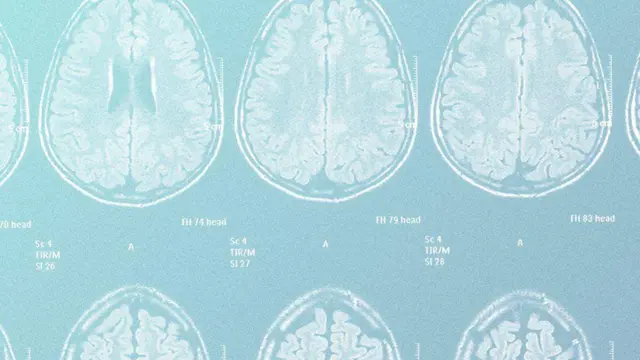 صور أشعة تليفزونية لحالات مختلفة من الدماغ وتأثير الصداع النصفي على شكل الدماغ