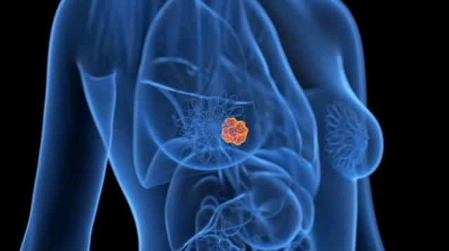 Imagem de um modelo digital do corpo humano em tons de azul, destacando um tumor em laranja no tecido mamário, representando avanços da inteligência artificial na detecção precoce de câncer.