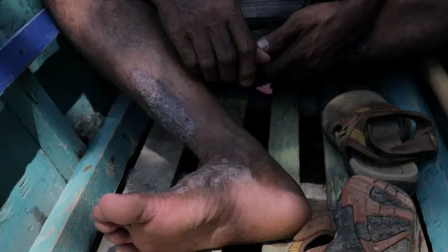 Kaki Mawi terdapat ruam.