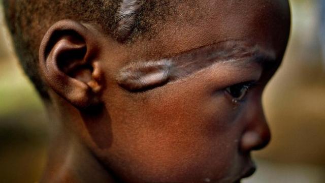 枪不是人类冲突爆发的先决条件——图中这位名叫孔索拉（Console）的胡图族难民小孩，他头部的伤疤是1994年卢旺达大屠杀中被弯刀砍伤留下的。
