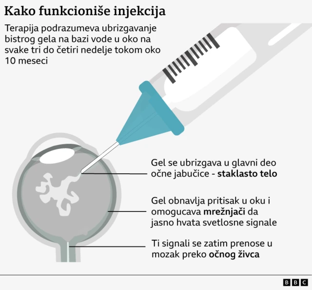 injekcija za oko, gel terapija za oko