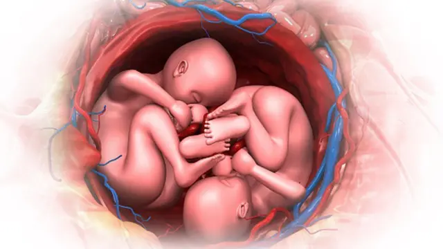 இரட்டைக் குழந்தைகளில் ஒன்றைக் கலைப்பது எவ்வளவு ஆபத்தானது?