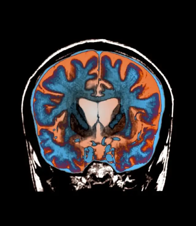 امآرآی از مغز جوان بیست و یک ساله مبتلا به هانتینگتون